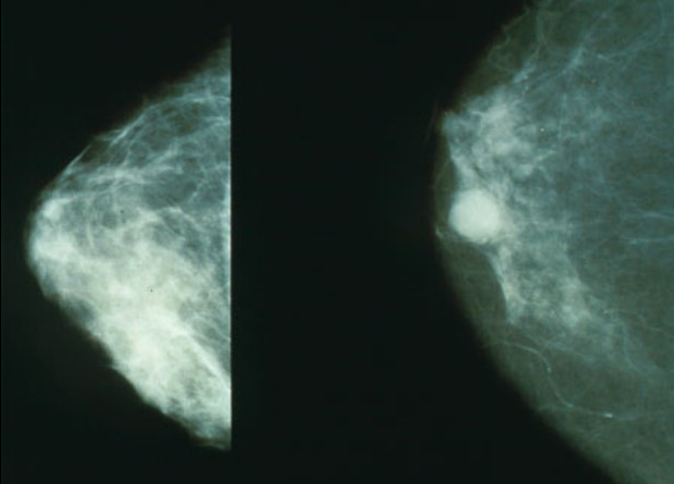 Imagen comparativas de mamografía. A la izquierda una mama saludable. A la derecha, con cáncer. Foto: National Cancer Institute a través de es.wikipedia.org